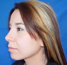 cosmetic nose surgery